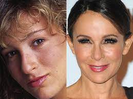 Since then, he's worn a prosthetic nose to hide the huge. Celebrity Plastic Surgery Disasters Cbs News