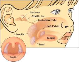 Image result for Tonsillectomy