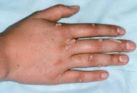 Can A Hand Job Cause An Std