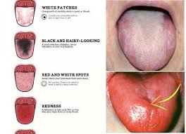 3 Key Signs Of Health You Can Read By Looking At Your Tongue Tongue Health Yeast Infection Causes White Tongue Causes