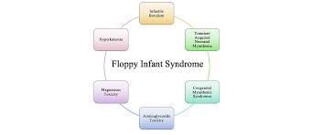 Image result for Floppy Infant