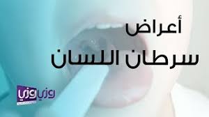 أعراض سرطان اللسان youtube