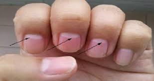 Acest lucru se datorează faptului că vasele de sânge de sub unghii nu se rup, așa că nu sângerează. Pata Alba Pe Unghie