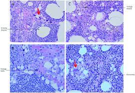 The foreign material may be discerned with the application of a light microscope along with a birefringence with polarized the granulomas may be necrotizing with an acentric caseous, cheese like necrosis accompanied by a. Granuloma Formation A Numerous Vacuoles In The Lymph Node Imparting Download Scientific Diagram