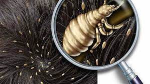 See full list on wikihow.com How To Check Yourself For Lice How To Tell If You Have Lice By Yourself Without A Comb Lice Eggs Paranoid Where To Be Checked