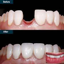 Considering dental implant surgery to replace missing or damaged teeth, but concerned about how bad it will hurt or the pain afterwards? Best Dental Implants In Brooklyn Ny Top Rated Implant Dentist