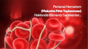 Perianal Hematom Makatta Pihti Toplanmasi Nedir Semptomlari Ve Tedavisi Prof Dr Sezai Leventoglu