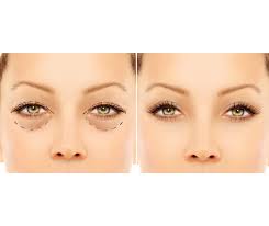 Blepharoplasty in Puerto Vallarta