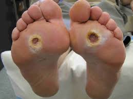 Image result for diabetic toes