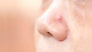Image result for skin cancer on nose pimple