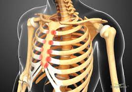 Costochondritis is a pain in the….rib. Backpod Helps Costochondritis And Tietze S Syndrome Bodystance
