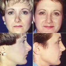 Revision Rhinoplasty