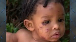 Dunn said some of the common questions she gets about the baby's hair are, can i touch it? and what do you do to it? and do you put hairspray in it? she and her husband, brian dunn, saw early signs their first child. Graphic 2 Year Old Allegedly Attacks 9 Month Old At Daycare