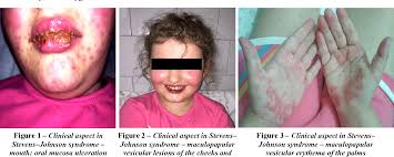 N engl j med 1995; Pdf Post Medication Stevens Johnson Syndrome In A Girl Hospitalized For A Norovirus And Rotavirus Infection Semantic Scholar