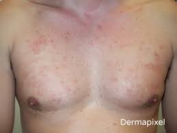 Dermapixel Unas Manchas Rojas En El Pecho