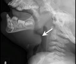 Image result for Epiglottitis