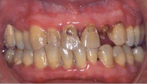 Resultado de imagen para caracteristicas del sarro dental