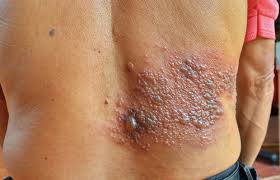 The herpes simplex virus impacts a significant portion of the worldwide population. Herpes Lakes Dermatology