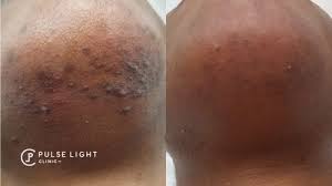 Countless women face excessive and unwanted facial hair. Laser Hair Removal Dark Skin Pulse Light Clinic London
