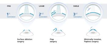 It works by using a laser to help the fluid in your eye drain away, which can help to lower the pressure inside your eye. Smile Lasik Or Prk Which Is Best Laservue Eye Center