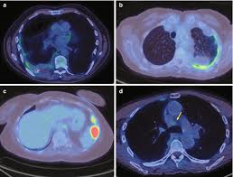 Scagliotti gv, iaslc 19th world conference on lung cancer 2018 (abstract pl02.09) Staging Of Malignant Pleural Mesothelioma Springerlink