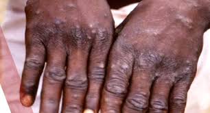 Human monkeypox often begins with a combination of the following symptoms: Monkeypox Virus The Nation Thecitizen It S All About You