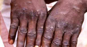 It can be transmitted through respiratory droplets, contact with body fluids or contact with an infected animal or animal products. Bayelsa Monkeypox Patient Takes Life In Hospital Daily Times Nigeria