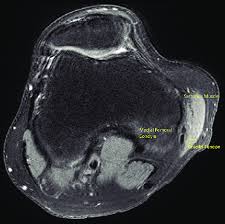 Magnetic resonance (mr) imaging is the preferred imaging modality for evaluating internal derangement of the knee, due to its superior soft . Medial Right Knee Mri Correlation Case 1 A 31 Year Old Male With Right Download Scientific Diagram