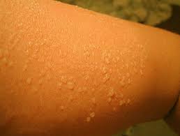 Young living products offer sunburn solutions and relief for irritated skin. Sunburn Blisters Pictures Looks Pretty Much Like This Blister Treatment Sunburn Remedies Sunburn Blisters