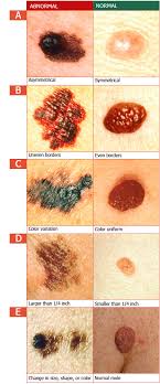 skin cancer abcde screening guidelines