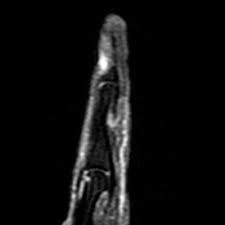 Image result for Glomus tumor