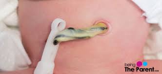 The umbilical cord stump usually falls off in. When Will My Baby S Umbilical Stump Fall Off Being The Parent