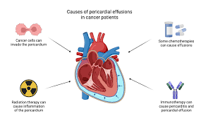 Image result for Pericardium