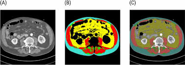 Sarcopenia and adipose tissue evaluation by artificial intelligence  predicts the overall survival after TAVI