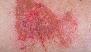 The severity of the rope burn will determine how long it takes to heal. Friction Burn On Penis Symptoms Treatment And Prevention