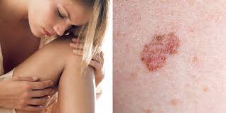 We also explore how it is diagnosed and the many treatment options now available should you be unfort. 10 Signs Of Skin Cancer You Shouldn T Ignore Self