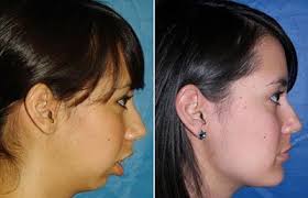 Orthognathic Jaw Surgery Melbourne