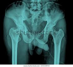 Image result for Hip XRay