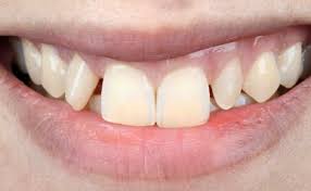 How long does it take before invisalign starts working. Invisalign Braces Complete Smiles