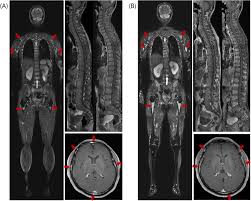 Multiple myeloma (mm) is a debilitating malignancy that is part of a spectrum of diseases ranging from monoclonal gammopathy of unknown significance (mgus) to plasma cell leukemia. Role Of Whole Body Mri For Treatment Response Assessment In Multiple Myeloma Comparison Between Clinical Response And Imaging Response Cancer Imaging Full Text