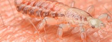 Image result for pubic lice symptoms