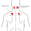 Back pain is a common problem often caused by overusing or misusing the muscles of the back. Https Encrypted Tbn0 Gstatic Com Images Q Tbn And9gctqovpq Sf Mpvu2u2j Bpg1vn2qfixmcwgdfqu3go5j3euyv6z Usqp Cau