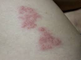 Image result for shingles in children