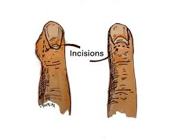 Image result for paronychium