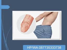 Operasi tiroid (tiroidektomi) pembedahan tiroid dapat dilakukan secara total atau sebagian. Contoh Sipilis Pada Pria Contoh Sipilis Pada Pria Obat Sipilis De Nature Sifilis Adalah Salah Satu Infeksi Penyakit Seksual Menular Yang Disebabkan Oleh Anda Bisa Tau Itu Sipilis Atau Bukan