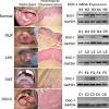 A painless lump on the lip, in the mouth, or in the throat a sore or ulceration on the lip or inside the mouth that does not heal painless white patches or red patches on the gums, tongue, or lining of the mouth 3