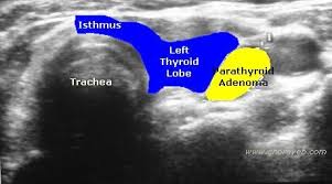 Parathyroid Adenoma Ultrasound Google Search Diagnostic Medical Sonography Thyroid Ultrasound Ultrasound