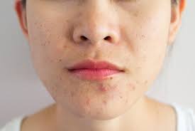 How To Get Rid Of Acne According To A Dermatologist Cnet