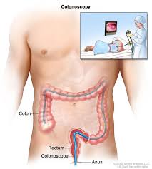 Your doctor will want to assess you to see if you need urgent referral if you are under 50 and have blood in your. Colonoscopy Niddk