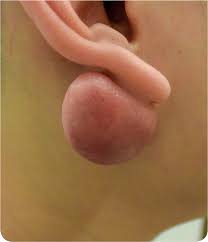 Skin cancer is the most common type of cancer in the united states by a pretty large margin, and it does not discriminate. Posterior Earlobe Mass Photo Quiz American Family Physician